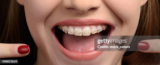 で私の歯列矯正器 - orthodontics ストックフォトと画像