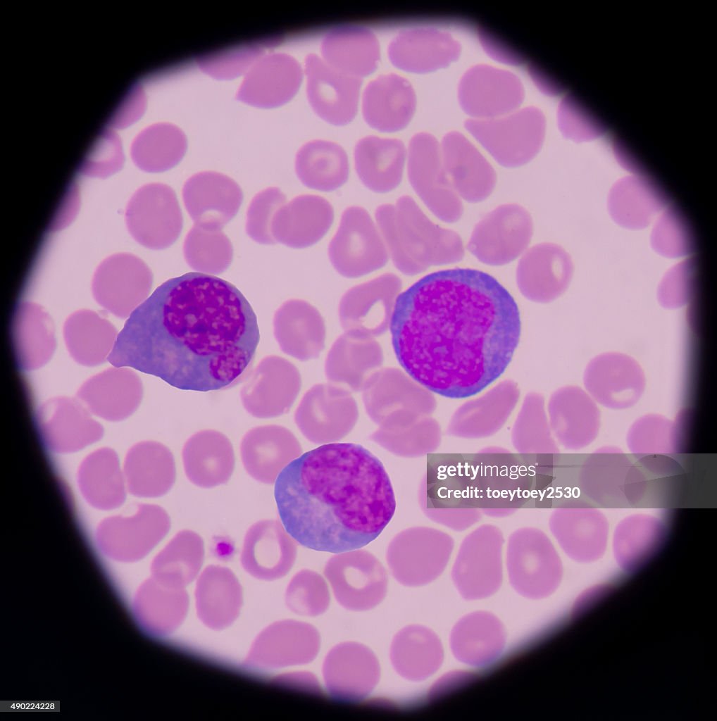 Variant Lymph Atypical Or Reactive Lymphocytes Are Lymphocytes That As A Re High-Res ...