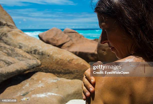 Woman has a sunburn at her back skin at Anse Petite on September 25, 2015 in La Passe, La Digue, Seychelles.