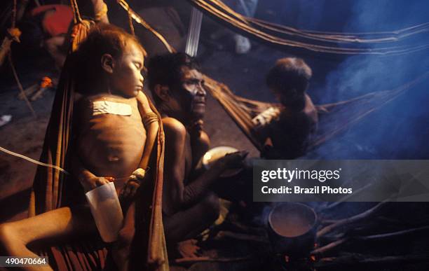 Gold mining inside Yanomami Indigenous People territory causing diseases and acculturation, sick under-feeded Yanomami child with malaria. Surucucus...