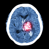 CT brain : show left thalamic hemorrhage (Hemorrhagic stroke)