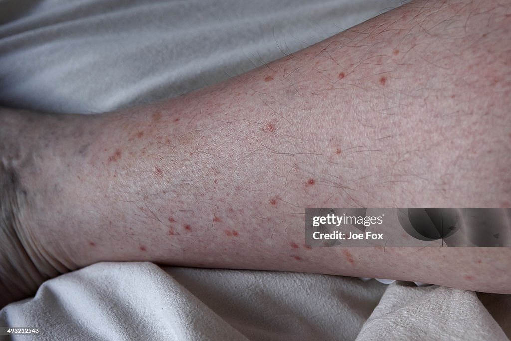 Mans lower leg ea and mosquito insect biteswith fl