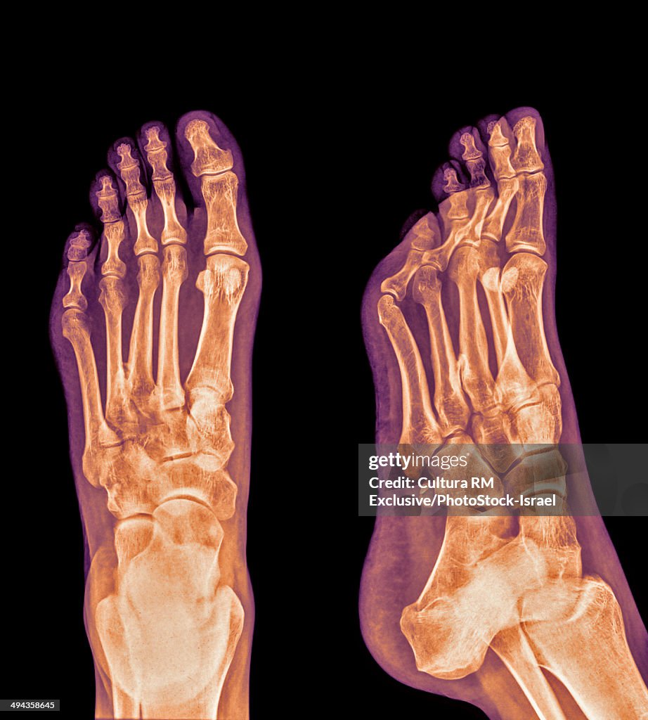 X-ray of heel with Plantar Fasciitis (Jogger's heel), 48 year old male