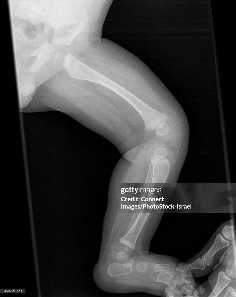 X-ray of 7 month old baby with distal fracture in femur