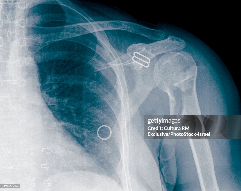 X-ray of fracture of Humerus bone after surgery, 64 year old female