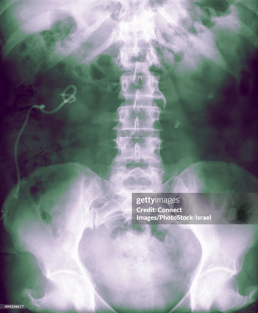 X-ray of abdomen, 50 year old female