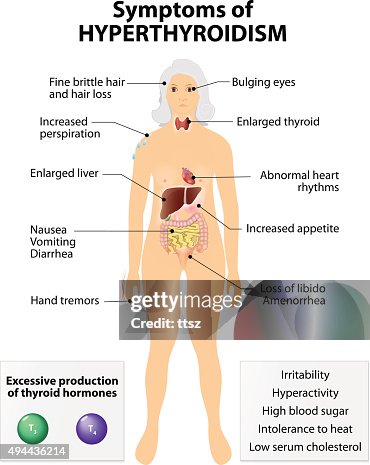 Hyperthyreosis Hyperthyroidism Or Over Active Thyroid Hyperthyreosis High-Res Vector ...