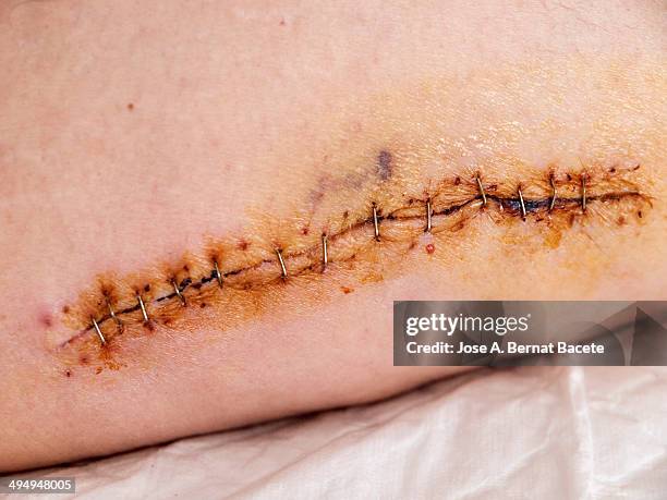 Stitched Wound Sutured With Metal Points, Foto de stock