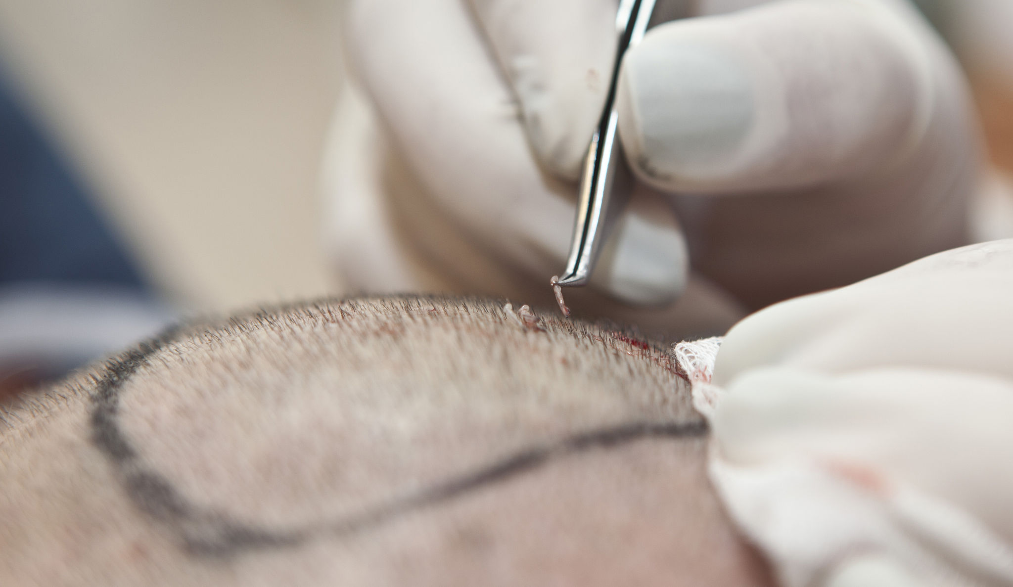 hair transplant surgery