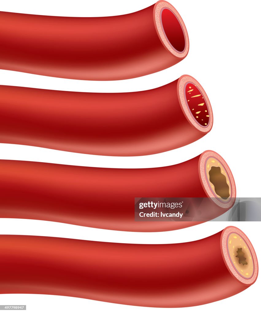Atherosclerosis