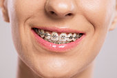 Healthy smile with braces