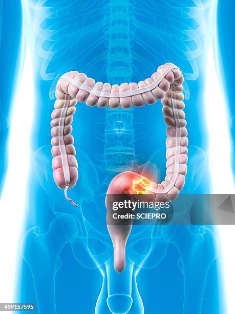 Large Intestinal Cancer 291 Large Intestine Cancer High Res Illustrations - Getty Images