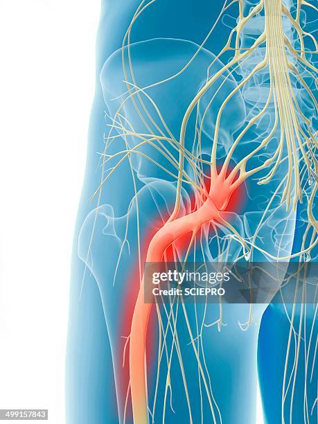 ilustraciones, imágenes clip art, dibujos animados e iconos de stock de inflamed sciatic nerve, artwork - sciatic