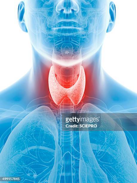 inflamed thyroid, artwork - thyroid gland stock-grafiken, -clipart, -cartoons und -symbole