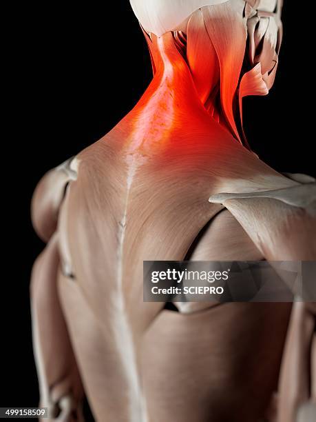 human neck muscles, artwork - neck muscle pain illustration stock illustrations