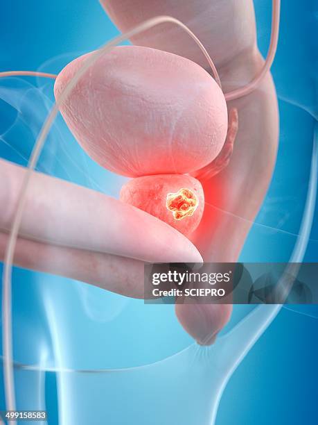 human prostate tumor, artwork - prostate gland stock illustrations