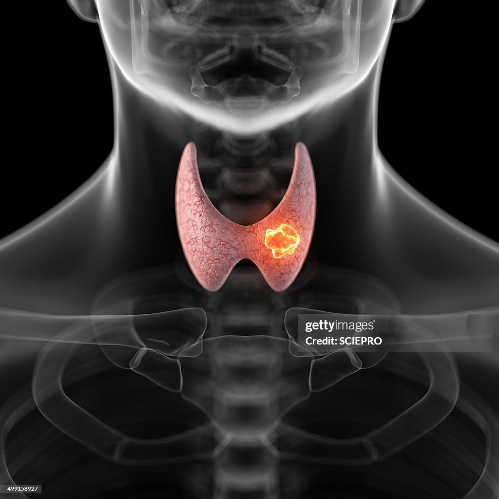 Tumor in human thyroid, artwork