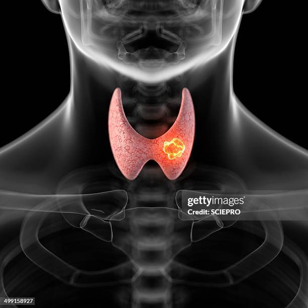 tumor in human thyroid, artwork - neck stock illustrations