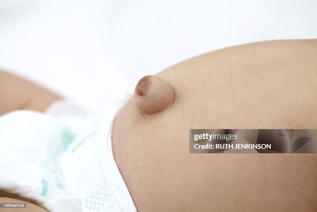 Baby with umbilical hernia