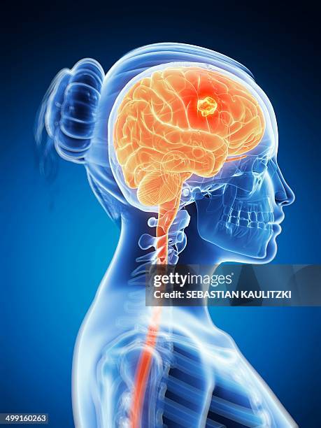 tumour in the brain, artwork - brain tumour stock illustrations