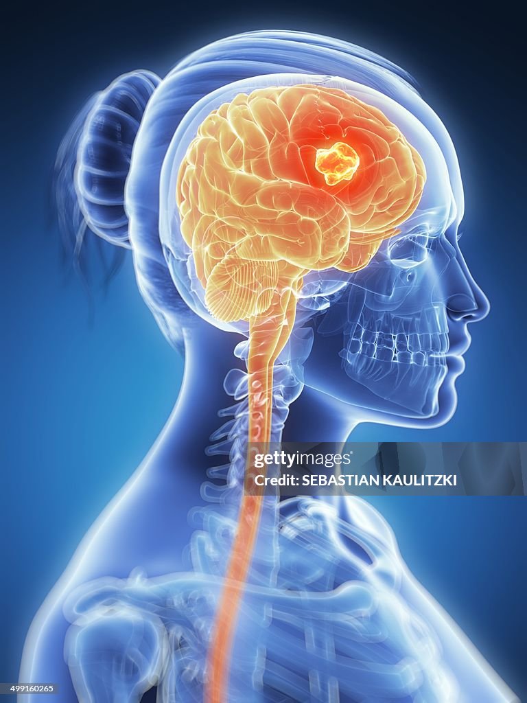 Tumour in the brain, artwork
