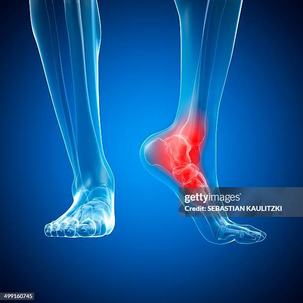illustrazioni stock, clip art, cartoni animati e icone di tendenza di human ankle, artwork - dolore fisico