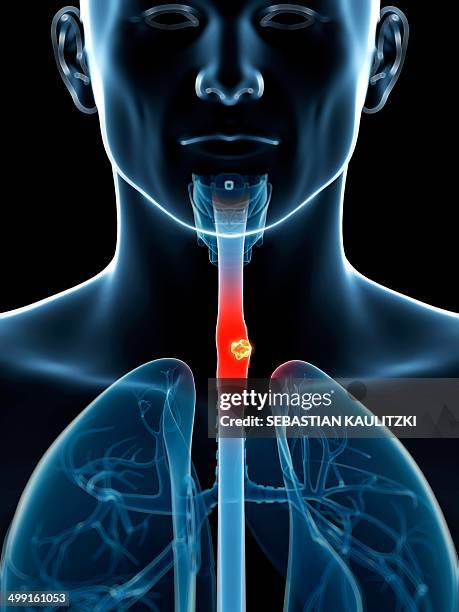 stockillustraties, clipart, cartoons en iconen met human food pipe with tumour, artwork - slokdarm