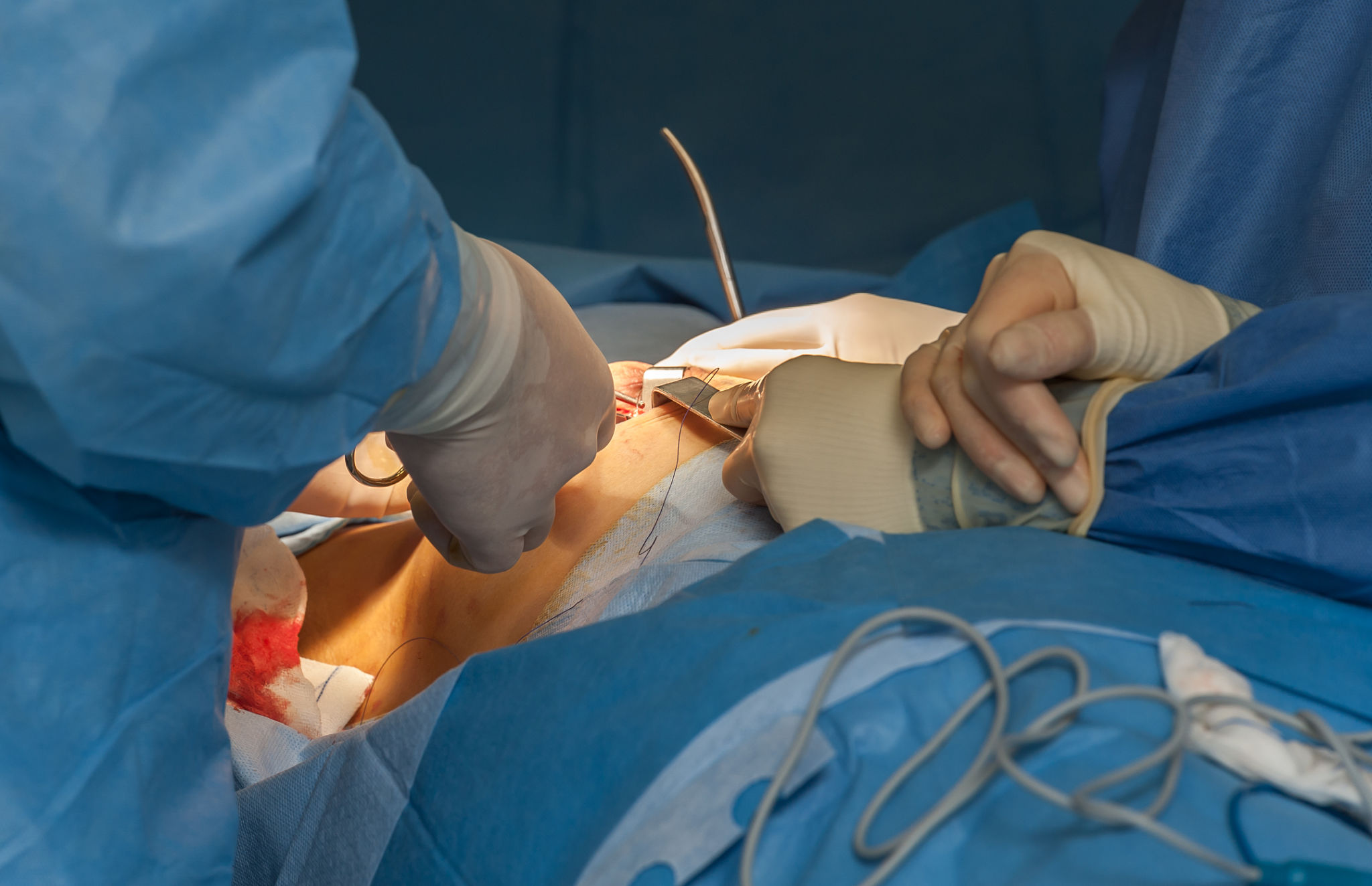breast surgery