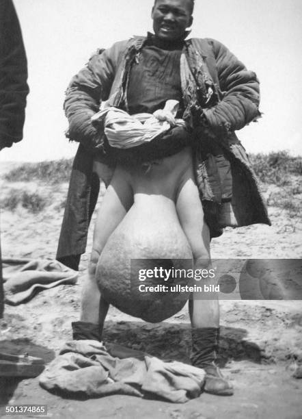 Japan, man suffers from Elephantiasis. - 1912/1913 - Photographer: Franz-Otto-Koch