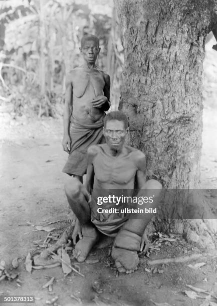 Africa, German East Africa, man suffers from Elephantiasis. - undated, probably around 1910 - Photographer: Haeckel