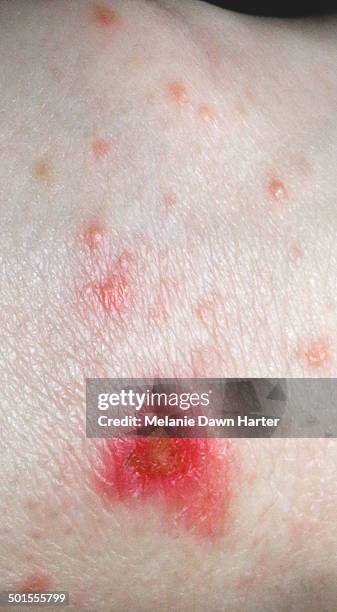 Exploding Pustules Pustules Photos and Premium High Res Pictures - Getty Images
