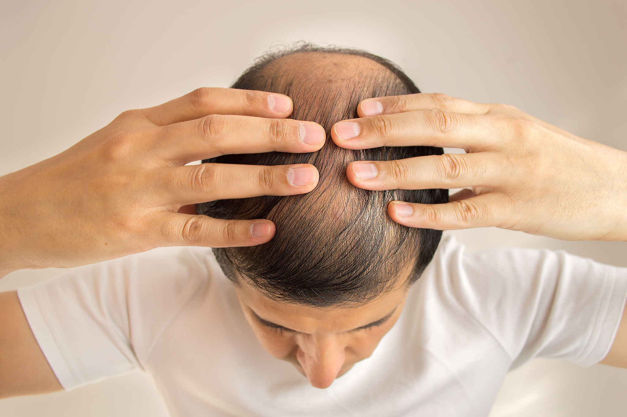 Perda de Cabelo Perda de Cabelo