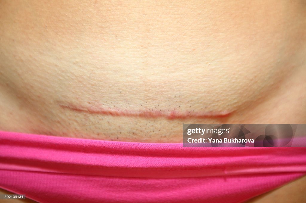 C-Section scar