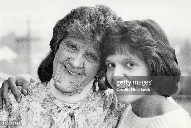 Margaret Muise; left and her daughter Rhonda are victims of neurofibromatosis; also known as the Elephant Man's disease.