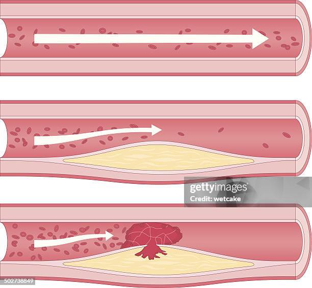 bildbanksillustrationer, clip art samt tecknat material och ikoner med atherosclerosis - plaque