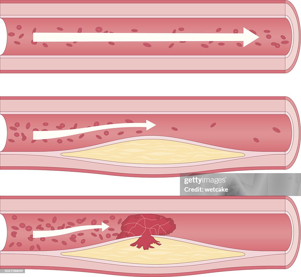 Atherosclerosis
