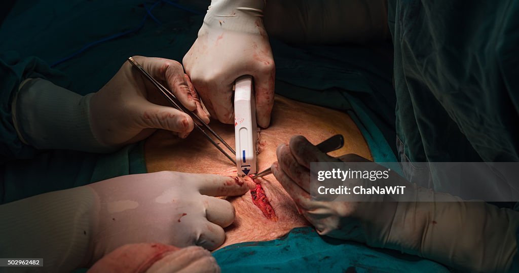Explore laparotomy