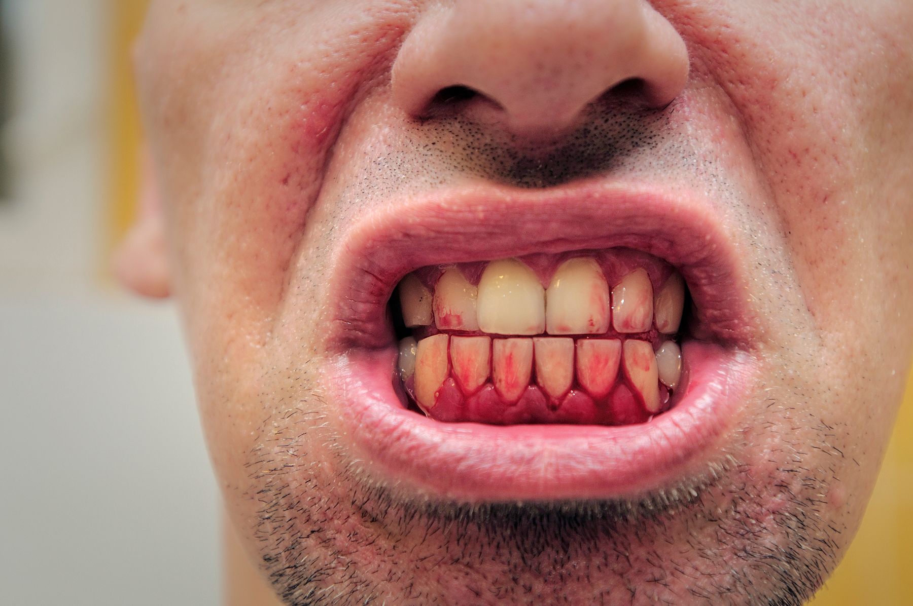 bleeding gums