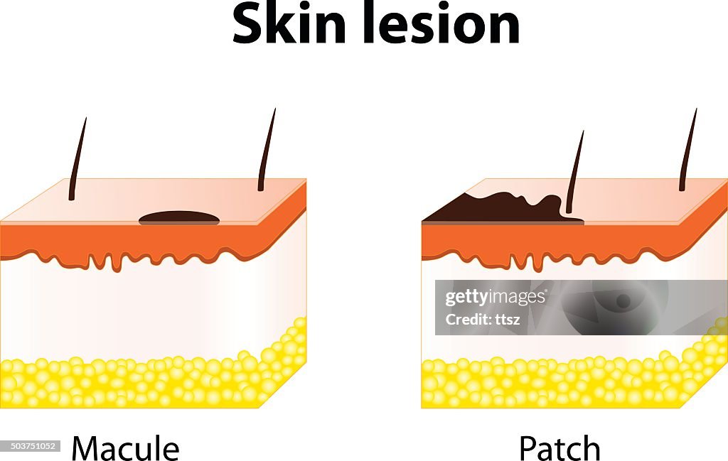 Maculated Macule And Patch Types Of Skin Lesions High-Res Vector Graphic - Getty ...