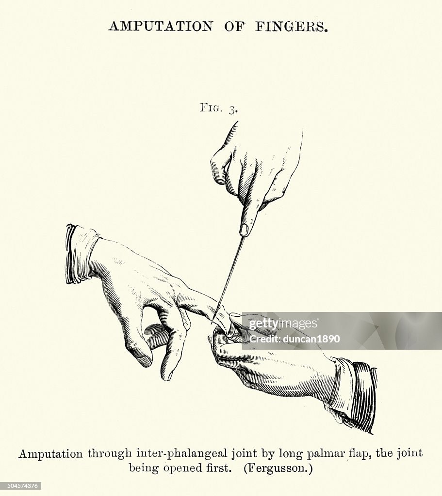 Medical History - Amputation of Fingers