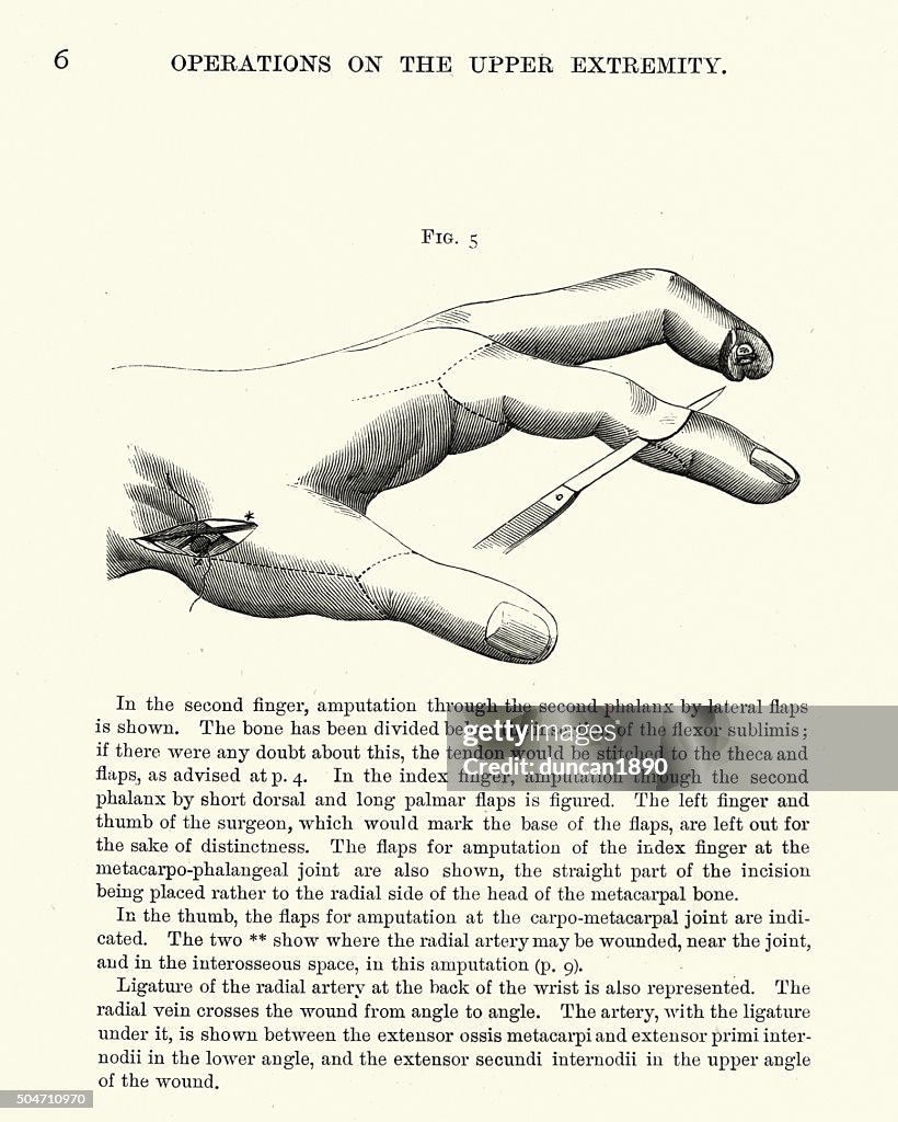 Medical History - Amputation of Fingers