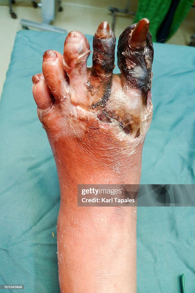 Foot gangrene