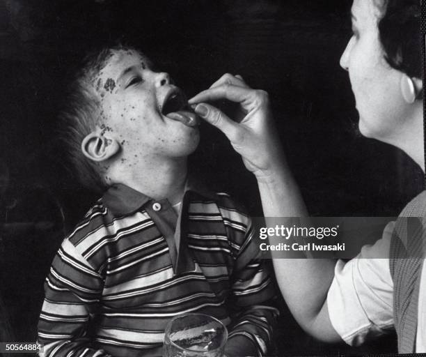 Boy with Chicken Pox taking pill called Termaril, prescribed to help relieve the itching.