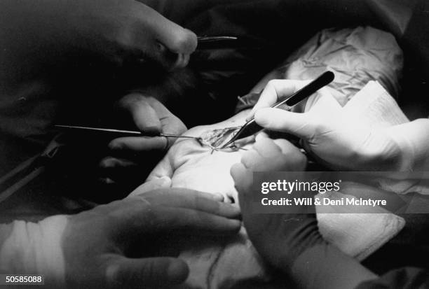 Closeup of hand surgery being performed on Carpal Tunnel Syndrome victim by hand surgeon Abner Bevin at Hand Rehabilitation center, Univ. Of NC.