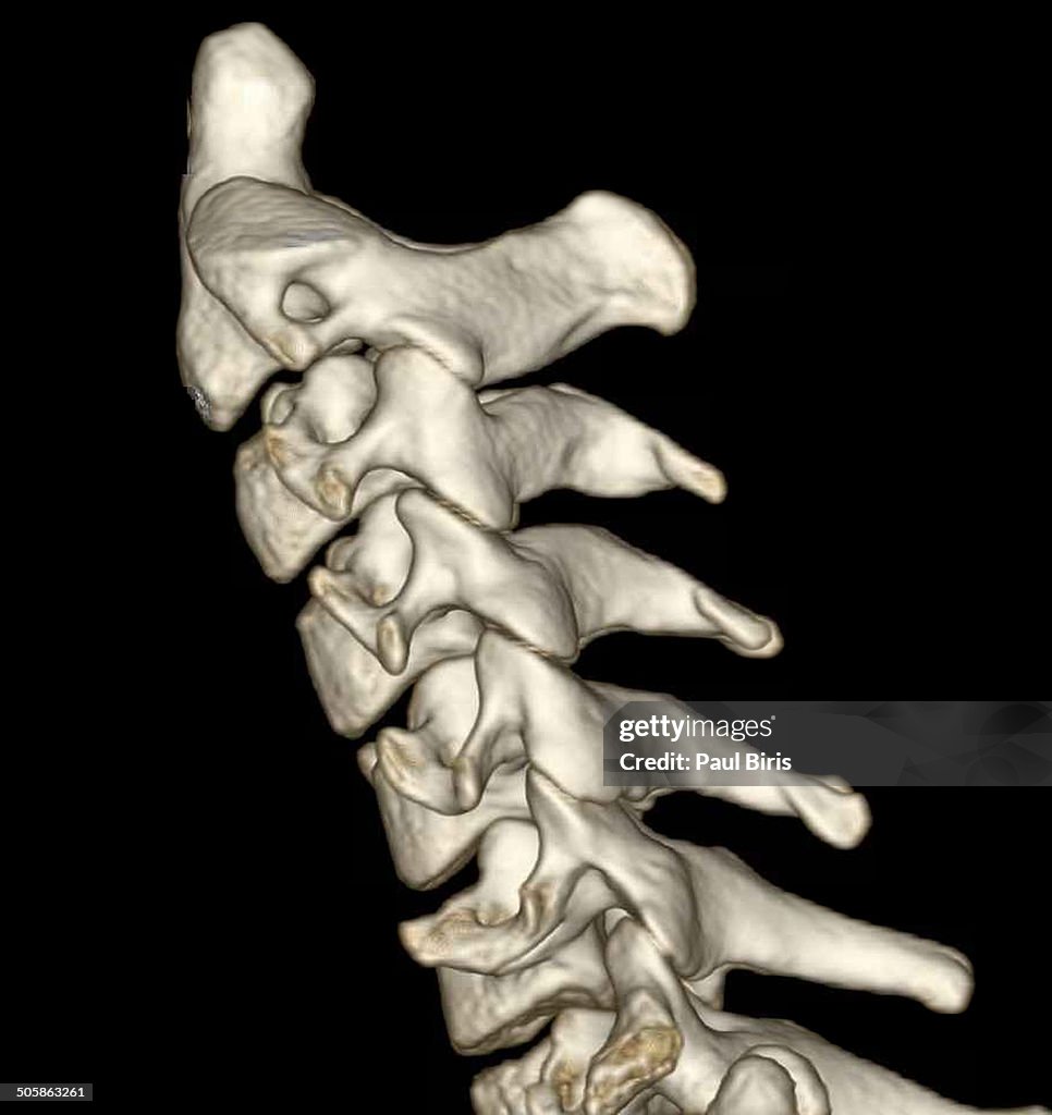 Cervical spine 3D CT