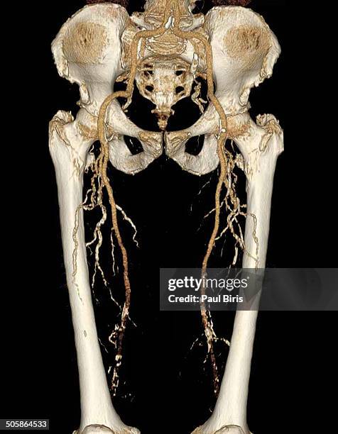 ct angiogram of pelvis and legs - ct angiography stock pictures, royalty-free photos & images