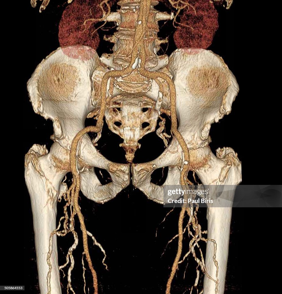 Angiogram In Leg 3dct Angiogram Of Pelvis And Legs High-Res Stock Photo - Getty Images