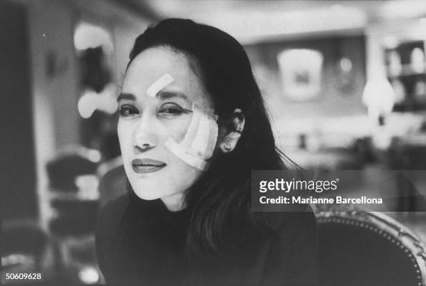 Minnie Osmena, the ex-wife of Carnation heir Dwight Stuart, w. Bandage on forehead & cheek after sustaining a slashing from a broken champagne glass...