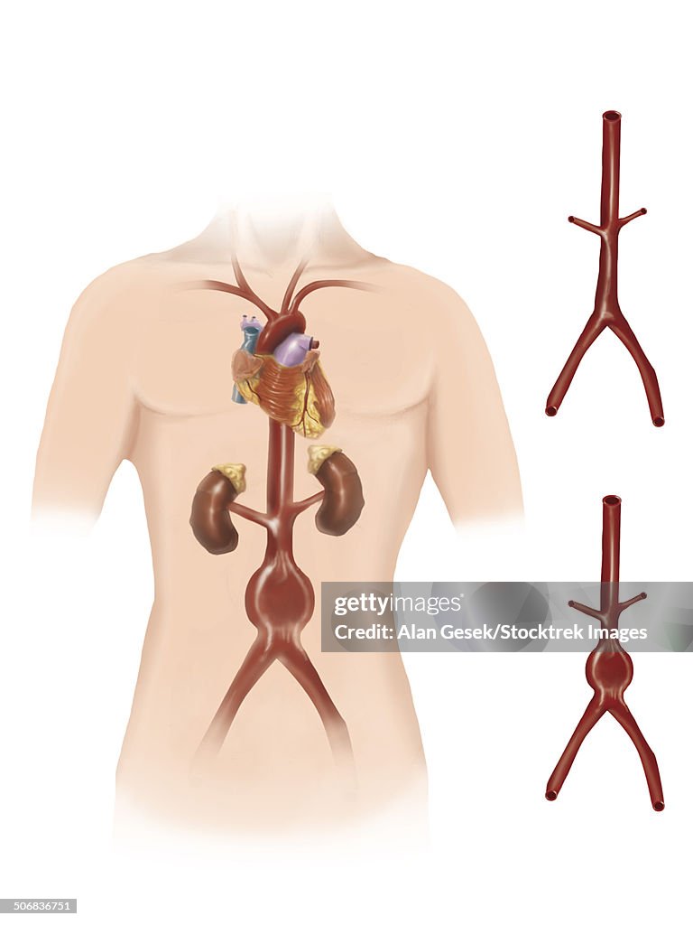 Artist depcition of abdominal aortic aneuryism.