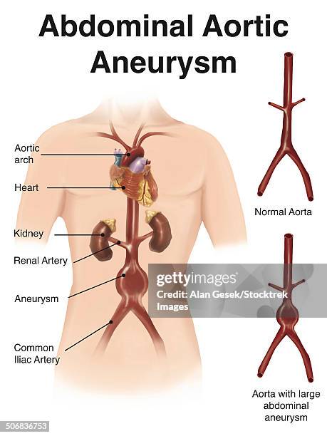 ilustraciones, imágenes clip art, dibujos animados e iconos de stock de artist depcition of abdominal aortic aneuryism (with labels). - aorta